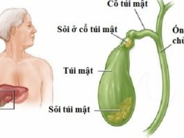 Sỏi đường mật