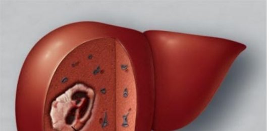 Giải phẫu bệnh học và triệu chứng bệnh ung thư gan