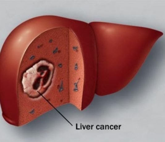 Giải phẫu bệnh học và triệu chứng bệnh ung thư gan