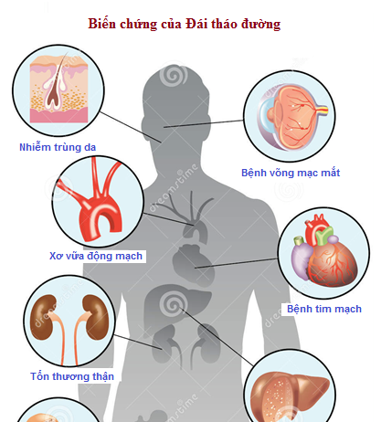 nguyên nhân và triệu chứng của bệnh đái tháo đường