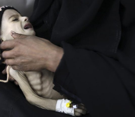 chế độ ăn cho trẻ suy dinh dưỡng