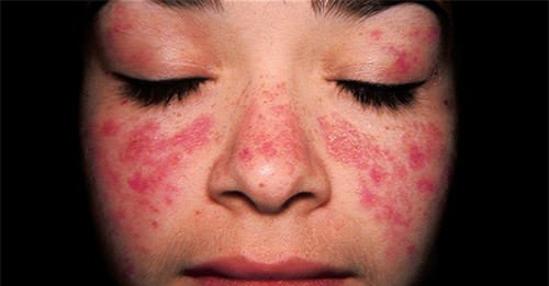 Chẩn đoán Lupus ban đỏ hệ thống