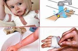 Cấp cứu bỏng và nhiệt độ cao