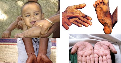 Chẩn đoán ngộ độc chì