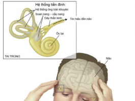 Rối loạn tiền đình và các nguyên nhân thường gặp