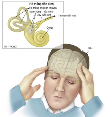 Rối loạn tiền đình và các nguyên nhân thường gặp