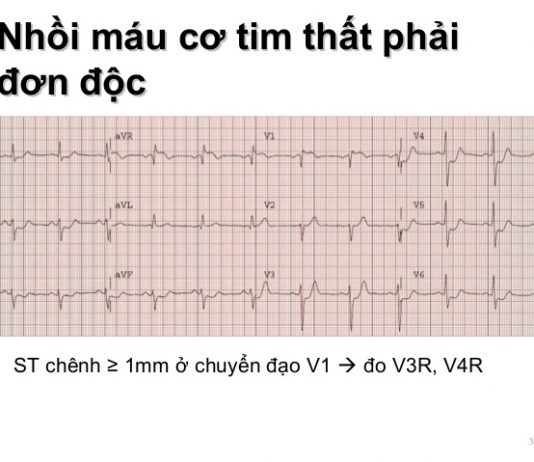 Nhồi máu cơ tim thất phải
