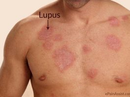 Các thuốc điều trị bệnh lupus ban đỏ hệ thống