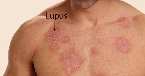 Các thuốc điều trị bệnh lupus ban đỏ hệ thống