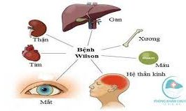 Điều trị bệnh Wilson (rối loạn chuyển hóa đồng)