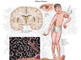 Chẩn đoán bệnh Wilson (rối loạn chuyển hóa đồng)