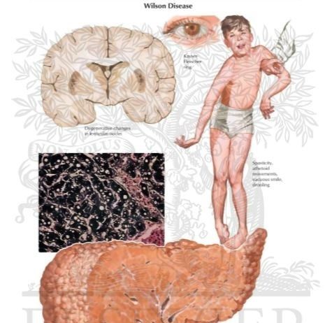Chẩn đoán bệnh Wilson (rối loạn chuyển hóa đồng)