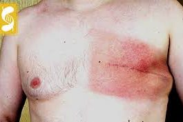 Nguyên nhân bệnh ung thư vú ở nam giới