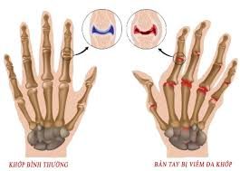 Triệu chứng bệnh viêm khớp dạng thấp