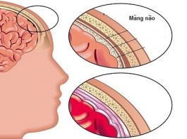 Nguyên nhân và triệu chứng của bệnh viêm màng não mủ trẻ em