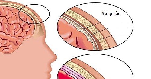 Nguyên nhân và triệu chứng của bệnh viêm màng não mủ trẻ em