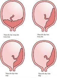 Rau tiền đạo – bệnh lý nguy hiểm trong sản khoa