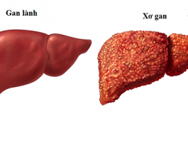 Nguyên nhân , triệu chứng của bệnh xơ gan