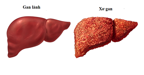 Nguyên nhân , triệu chứng của bệnh xơ gan