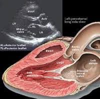 Nguyên nhân , triệu chứng và điều trị hở van hai lá