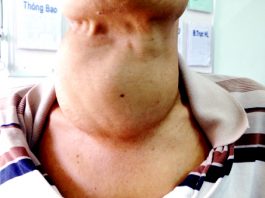 Bướu cổ đơn thuần – bệnh sinh, cách phòng và điều trị