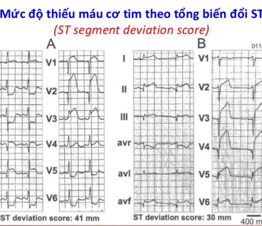 Sự khác biệt về giới trong thiếu máu cơ tim