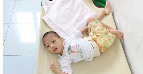 Phục hồi chức năng đối với trẻ bại não