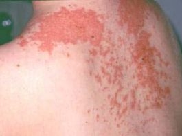 Nhiễm độc da dị ứng thuốc