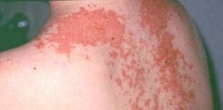 Nhiễm độc da dị ứng thuốc