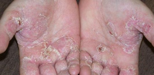 Tổn thương cơ bản trong bệnh da liễu