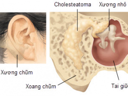 Viêm xương chũm cấp