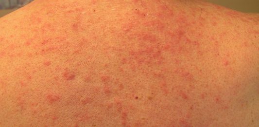 Bệnh da có mụn mủ ở nang lông