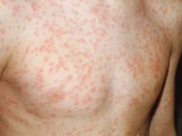 Hội chứng phát ban