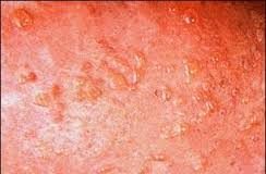 Bệnh Duhring-Brocq