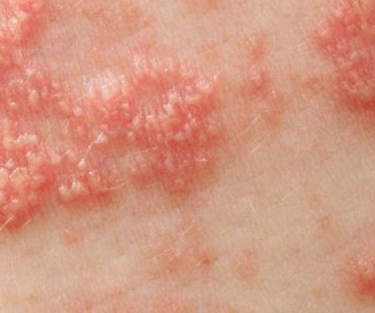 Zona và cách điều trị