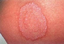 Yếu tố dịch tễ và cận lâm sàng bệnh nấm ngoài da