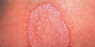 Yếu tố dịch tễ và cận lâm sàng bệnh nấm ngoài da