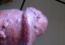 Triệu chứng lâm sàng bệnh Herpes