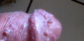 Triệu chứng lâm sàng bệnh Herpes