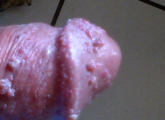 Triệu chứng lâm sàng bệnh Herpes