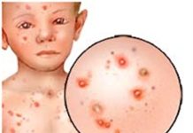 Triệu chứng lâm sàng và cận lâm sàng bệnh thủy đậu