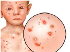 Triệu chứng lâm sàng và cận lâm sàng bệnh thủy đậu