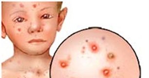 Triệu chứng lâm sàng và cận lâm sàng bệnh thủy đậu