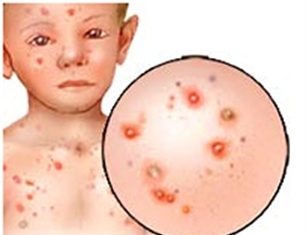 Triệu chứng lâm sàng và cận lâm sàng bệnh thủy đậu