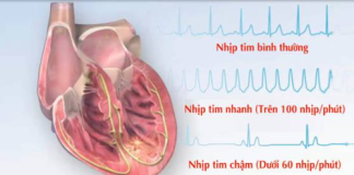 CÁC RỐI LOẠN NHỊP NHANH