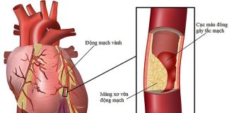 CÁC RỐI LOẠN NHỊP TIM TRONG HỘI CHỨNG VÀNH CẤP