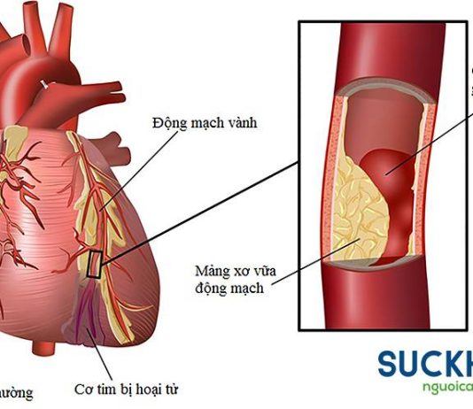 CÁC RỐI LOẠN NHỊP TIM TRONG HỘI CHỨNG VÀNH CẤP