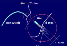 Cắt đốt qua cathter các rối loạn nhịp thất tồn tại trong hội chứng vành cấp