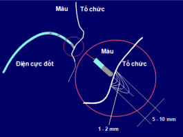 Cắt đốt qua cathter các rối loạn nhịp thất tồn tại trong hội chứng vành cấp