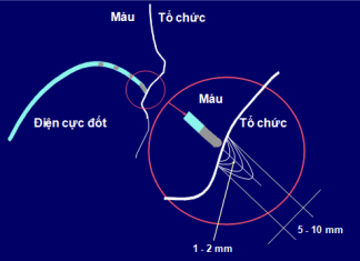 Cắt đốt qua cathter các rối loạn nhịp thất tồn tại trong hội chứng vành cấp